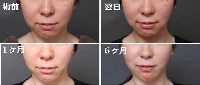 顔の脂肪吸引 6ヶ月後 福田越の痩身 脂肪吸引ブログ