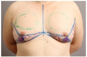 女性化乳房 ベイザー脂肪吸引